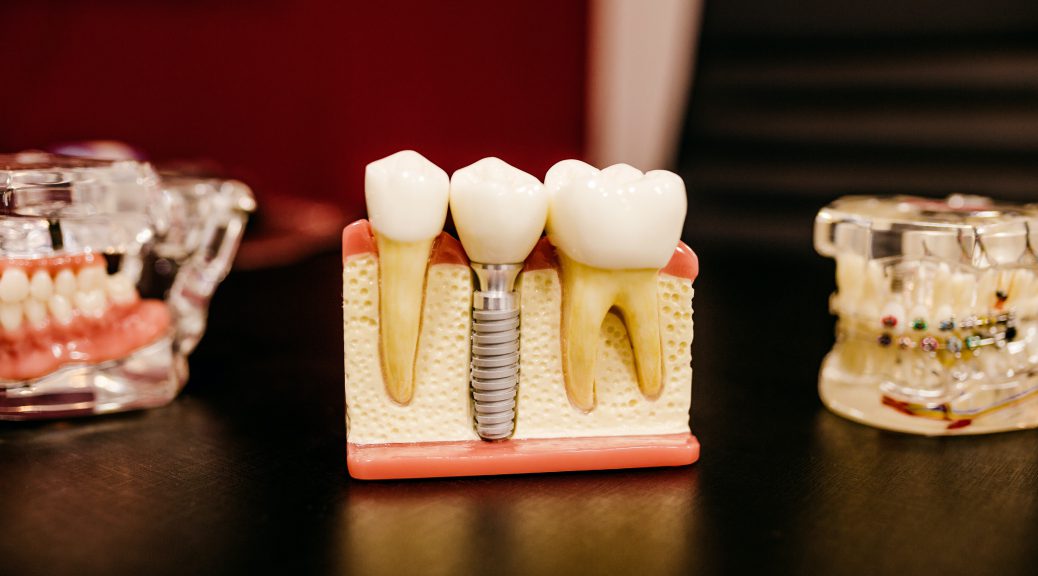 Kraków implant zęba